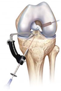 rekonsrtukcja acl01 202x300