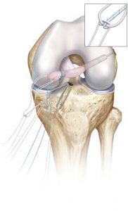 rekonsrtukcja acl04 182x300