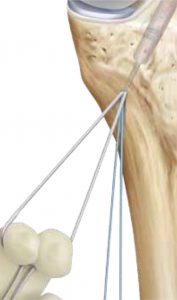 rekonsrtukcja acl05 177x300