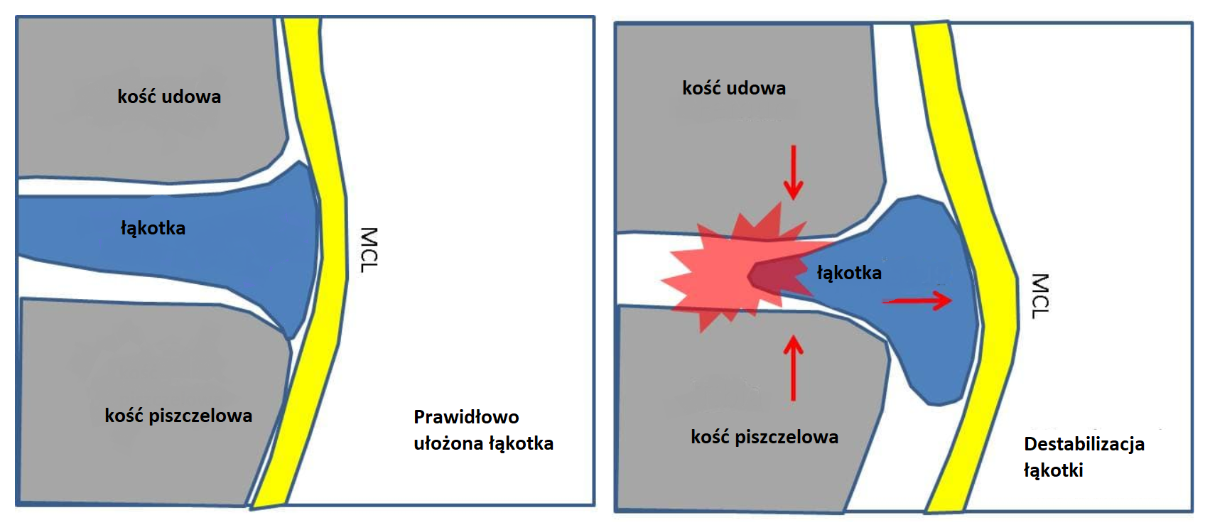 destabilizacja lakotki 2