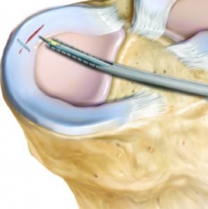 Szycie łąkotki (All-Inside Arthrex Meniscal Cinch) opis + technika operacyjna