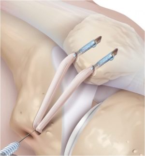 Anatomiczna dwupęczkowa rekonstrukcja troczków rzepki (MPFL)