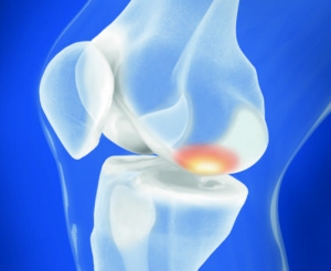 Rekonstrukcja chrząstki stawowej (Autologous Matrix-Induced Chondrogenesis, AMIC®, Chondro-Gide®) - technika operacyjna