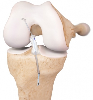Technika operacyjna reinsercji ACL metodą Internal Brace™